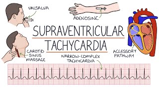 Understanding Supraventricular Tachycardia SVT [upl. by Shanon78]