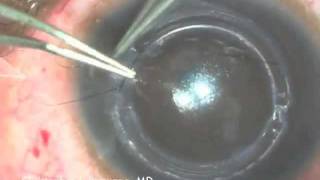 Intacs Insertion for Keratoconus [upl. by Engedi]