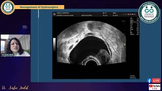 Managing Hydrosalpinx before IVF [upl. by Vasiliu12]