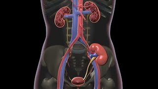 What causes kidney stones  Arash Shadman [upl. by Henn]