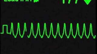 Monomorphic Ventricular Tachycardia  ECG Simulator  Arrhythmia Simulator [upl. by Emmy436]