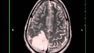 Oligodendroglioma [upl. by Esinet205]