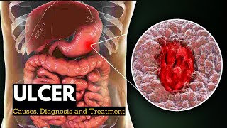 Ulcer Causes Signs and Symptoms Diagnosis and Treatment [upl. by Jude315]