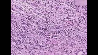 Histopathology StomachAdenocarcinoma [upl. by Llemor]