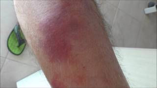 Cellulitis on a patients shin before and 4 days after treatment [upl. by Matthia]