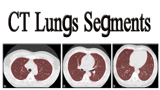 CT lungs segments [upl. by Nylesoj364]