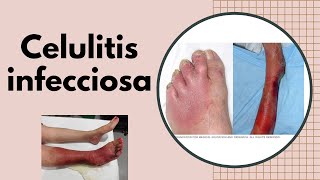 ERISIPELA y CELULITIS INFECCIOSA ¿ES CONTAGIOSA ¿Qué secuelas deja la celulitis que debo hacer [upl. by Akinnor]