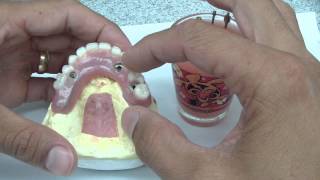 Overdenture Abutment Part 1 [upl. by Avat]