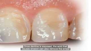 Common Dental Problems Erosion [upl. by Anielram]