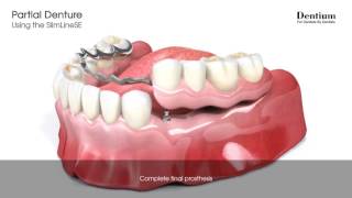 Partial denture  SlimLineSE [upl. by Ben177]