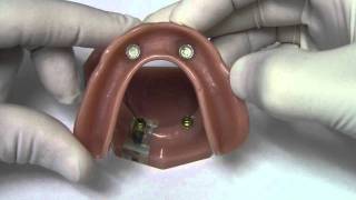 Implant Overdenture  Model Demonstration [upl. by Bronwen5]