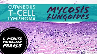 Overview Diagnosis And Staging of Cutaneous Lymphoma [upl. by Neeloj]