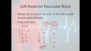 Left Anterior Fascicular Block  How to Read an Electrocardiogram EKG  MEDZCOOL [upl. by Akcebar]