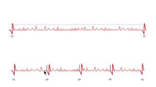 Pacemaker Issues Explained Part 3 Navigating Oversensing [upl. by Naesyar]