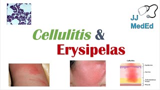 Cellulitis vs Erysipelas  Bacterial Causes Risk Factors Signs and Symptoms Treatment [upl. by Ihn]