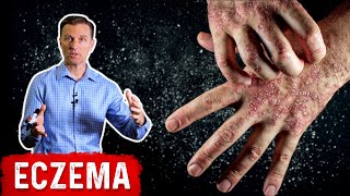 7 TYPES OF ECZEMA YOU NEED TO KNOW [upl. by Oni]