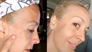 ELIMINAR las MANCHAS o paños de la piel  MELASMA [upl. by Leong]