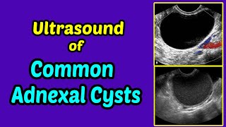 Can Ovarian Cysts reoccur  Dr Nupur Sood [upl. by Ekle517]