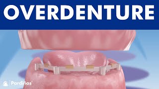 Overdenture with dental implants © [upl. by Krystal]