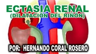 ECTASIA RENAL DILATACIÓN DEL RIÑÓN [upl. by Raddy]