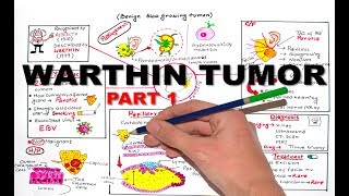 Warthin Tumor Salivay Gland Neoplasm  part 1 [upl. by Ahsenre]