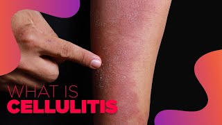 What is Cellulitis  Symptoms and Treatment Options [upl. by Uta]