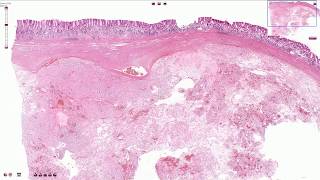 Gastrointestinal Stromal Tumor GIST  Histopathology [upl. by Isidora]