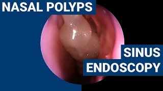 Nasal polyps  PHACON Sinus Patient Meyer [upl. by Oliy527]