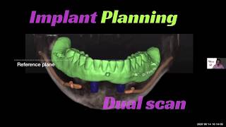 Implant Overdenture Treatment Planning Surgical and Restorative Guidelines [upl. by Salkcin998]