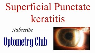 Superficial Punctate Keratitis Introduction Diagnosis and Treatment [upl. by Eide959]